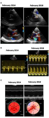 Cardiologic Long-Term Follow-Up of Patients Treated With Chest Radiotherapy: When and How?